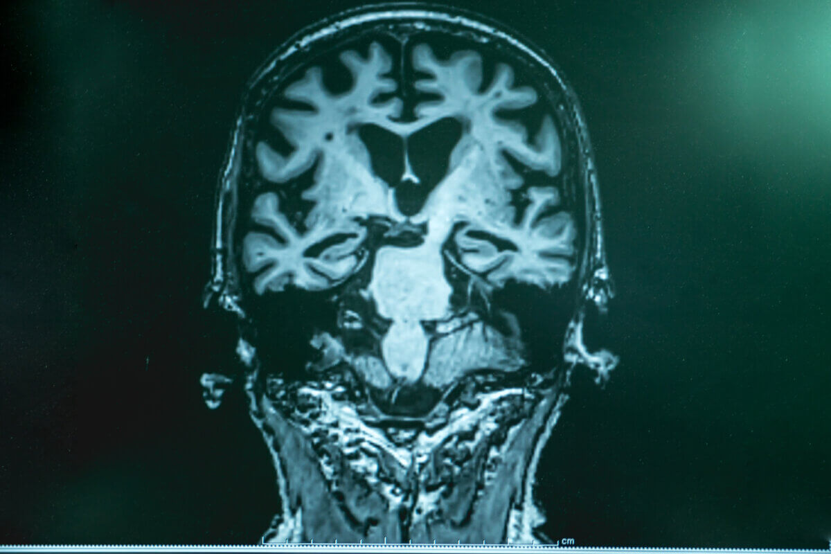 MRI of Alzheimer's dementia patient's brain